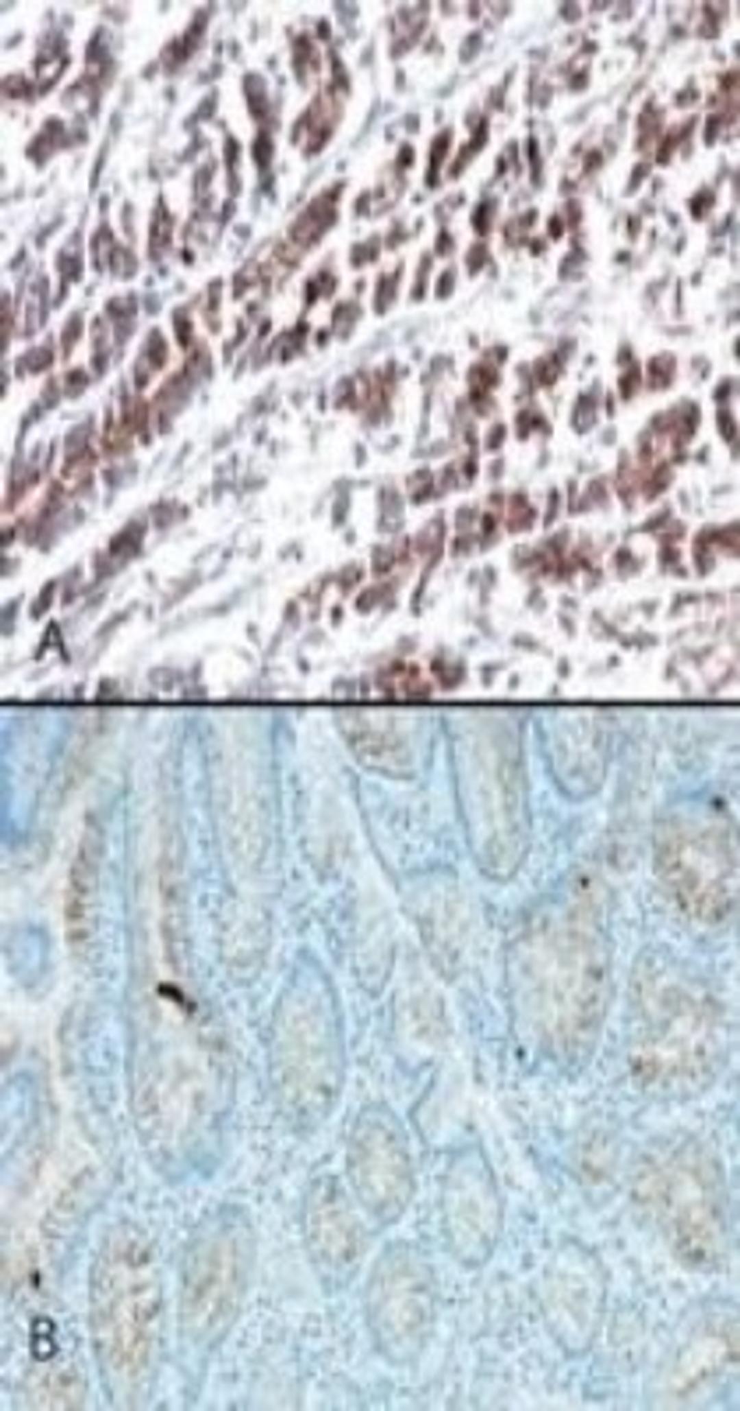 Immunohistochemistry: HtrA2 Antibody (196C429) [NB100-56558] - Immunohistochemical analysis of HtrA2 using an HtrA2 monoclonal antibody. Probing with HtrA2 antibody shows staining in stomach tumor tissue (A) and very weak staining in normal stomach tissue (B).