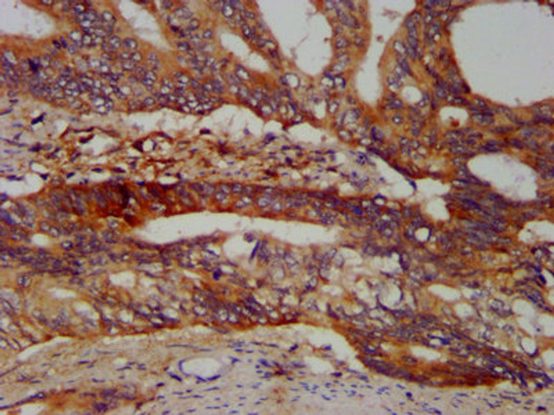 IHC image of CSB-PA897481LA01HU diluted at 1:400 and staining in paraffin-embedded human colon cancer performed on a Leica BondTM system. After dewaxing and hydration, antigen retrieval was mediated by high pressure in a citrate buffer (pH 6.0). Section was blocked with 10% normal goat serum 30min at RT. Then primary antibody (1% BSA) was incubated at 4°C overnight. The primary is detected by a biotinylated secondary antibody and visualized using an HRP conjugated SP system.