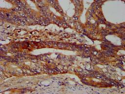 IHC image of CSB-PA897481LA01HU diluted at 1:400 and staining in paraffin-embedded human colon cancer performed on a Leica BondTM system. After dewaxing and hydration, antigen retrieval was mediated by high pressure in a citrate buffer (pH 6.0). Section was blocked with 10% normal goat serum 30min at RT. Then primary antibody (1% BSA) was incubated at 4°C overnight. The primary is detected by a biotinylated secondary antibody and visualized using an HRP conjugated SP system.