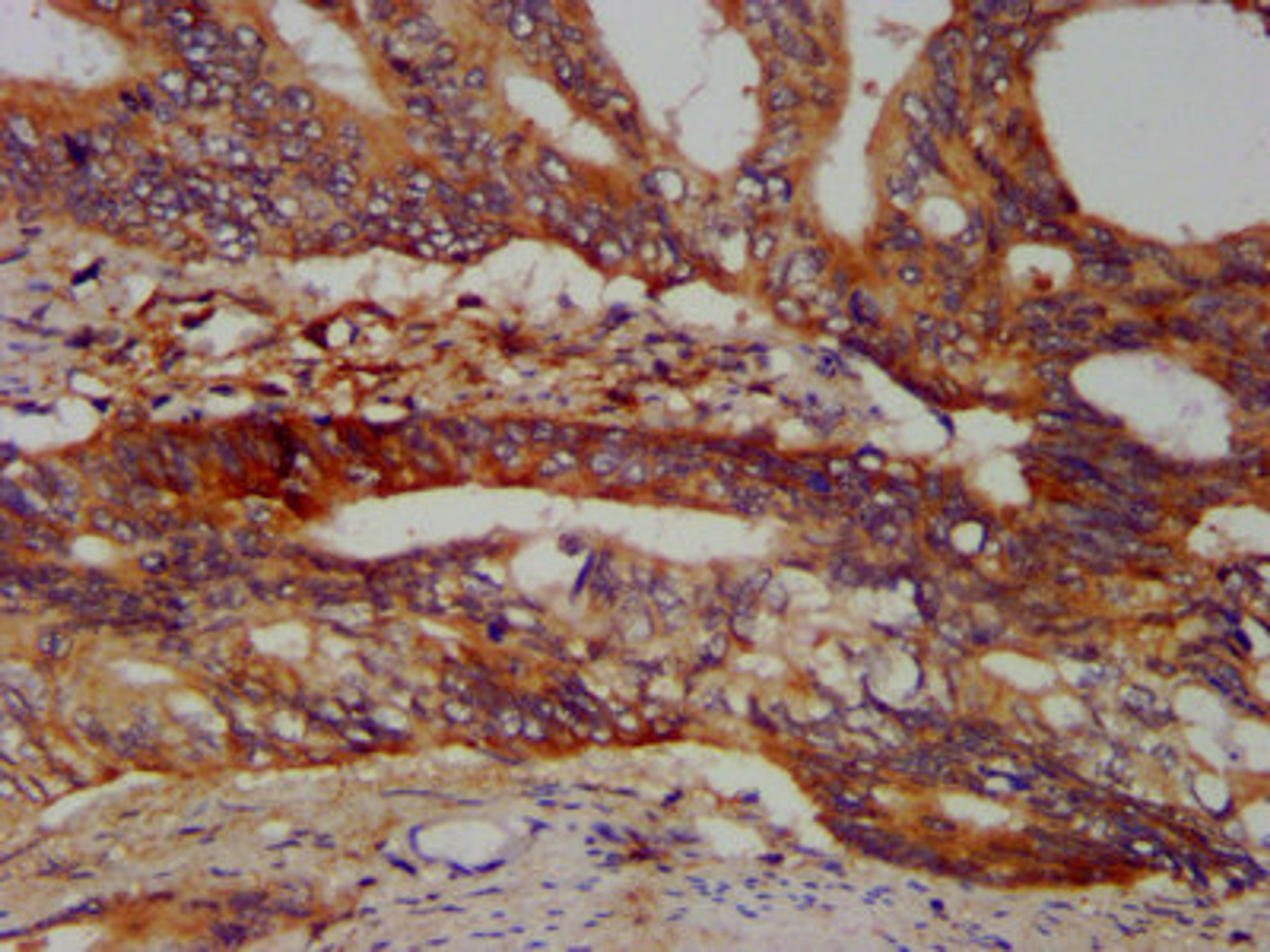 IHC image of CSB-PA897481LA01HU diluted at 1:400 and staining in paraffin-embedded human colon cancer performed on a Leica BondTM system. After dewaxing and hydration, antigen retrieval was mediated by high pressure in a citrate buffer (pH 6.0). Section was blocked with 10% normal goat serum 30min at RT. Then primary antibody (1% BSA) was incubated at 4°C overnight. The primary is detected by a biotinylated secondary antibody and visualized using an HRP conjugated SP system.