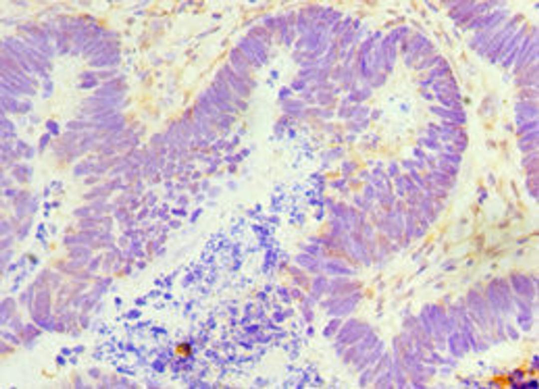 Immunohistochemistry of paraffin-embedded human ovarian cancer using CSB-PA009349ESR1HU at dilution of 1:100