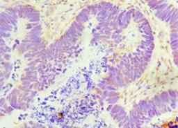 Immunohistochemistry of paraffin-embedded human ovarian cancer using CSB-PA009349ESR1HU at dilution of 1:100