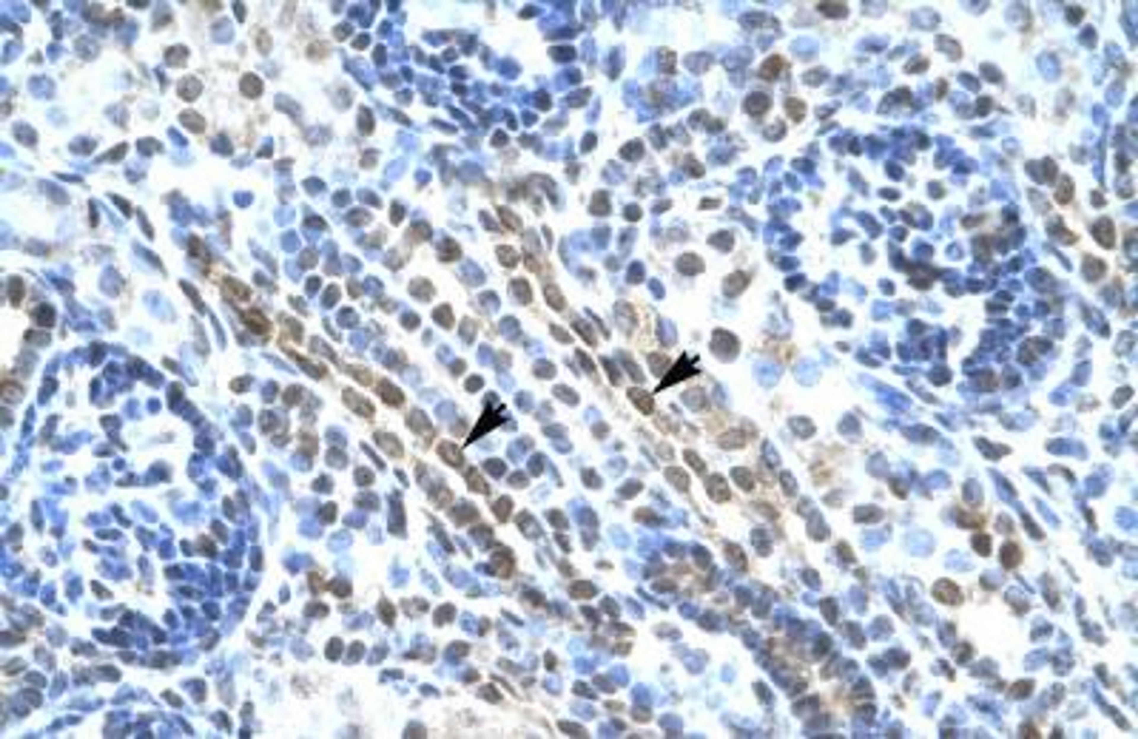 Immunohistochemistry-Paraffin: ANKRD11 Antibody [NBP1-52984] - Human kidney Tissue, antibody concentration 4-8ug/ml. Cells with positive label: renal corpuscle cells (indicated with arrows) 400X magnification.