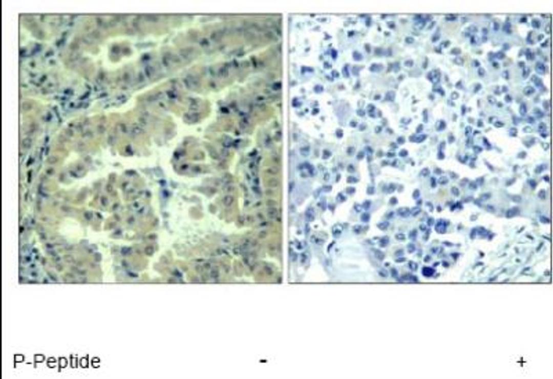 Immunohistochemistry: eIF4G1 [p Ser1232] Antibody [NBP1-04965] - eIF4G1 [p Ser1232] Antibody Immunohistochemical analysis of paraffin-embedded  human lung carcinoma tissue using eIF4G (phospho-  Ser1232) antibody