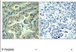 Immunohistochemistry: eIF4G1 [p Ser1232] Antibody [NBP1-04965] - eIF4G1 [p Ser1232] Antibody Immunohistochemical analysis of paraffin-embedded  human lung carcinoma tissue using eIF4G (phospho-  Ser1232) antibody