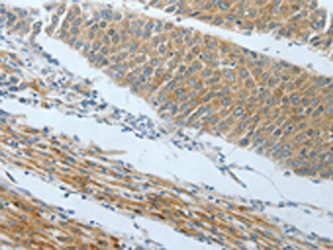 The image on the left is immunohistochemistry of paraffin-embedded Human liver cancer tissue using CSB-PA068489(AMPH Antibody) at dilution 1/25, on the right is treated with fusion protein. (Original magnification: ×200)