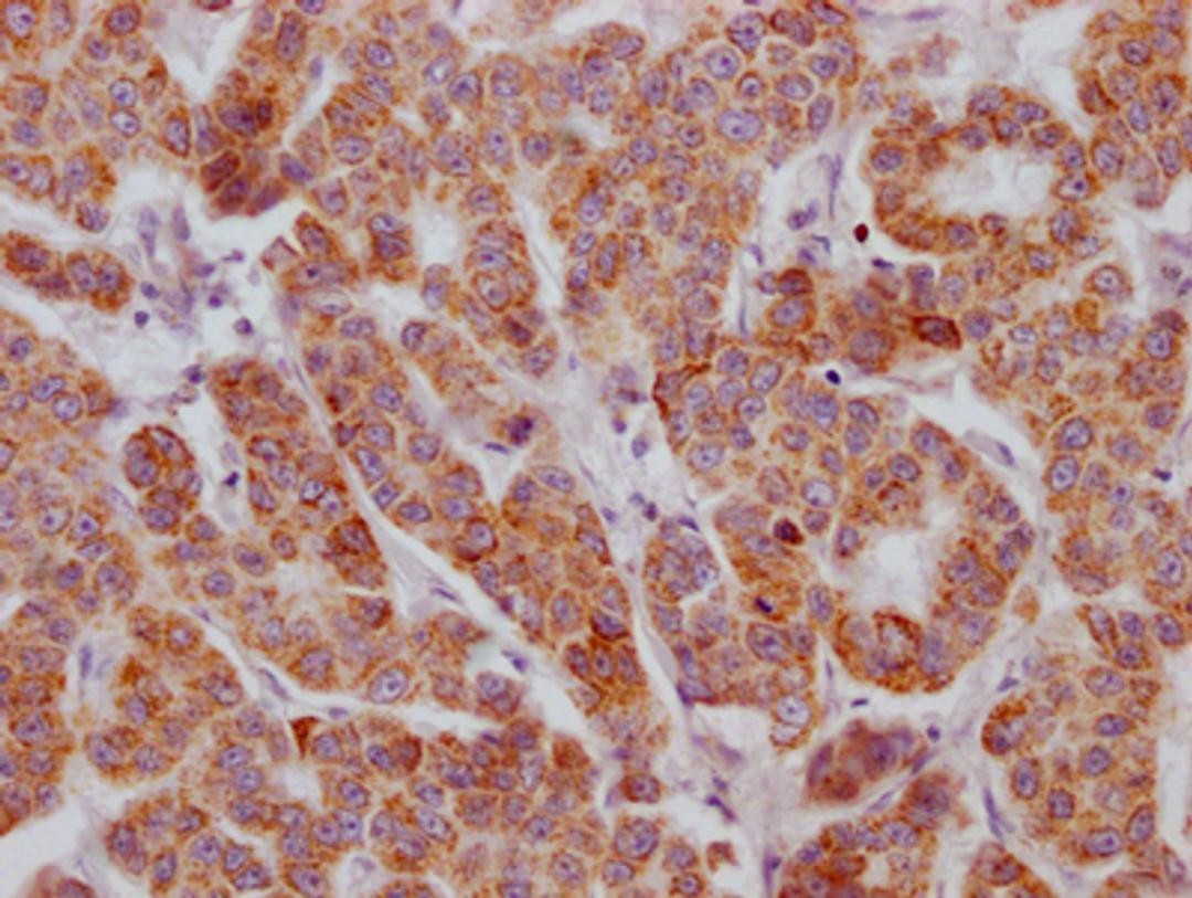 IHC image of CSB-RA260702A0HU diluted at 1:100 and staining in paraffin-embedded human breast cancer performed on a Leica BondTM system. After dewaxing and hydration, antigen retrieval was mediated by high pressure in a citrate buffer (pH 6.0). Section was blocked with 10% normal goat serum 30min at RT. Then primary antibody (1% BSA) was incubated at 4℃ overnight. The primary is detected by a Goat anti-rabbit IgG polymer labeled by HRP and visualized using 0.05% DAB.