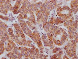 IHC image of CSB-RA260702A0HU diluted at 1:100 and staining in paraffin-embedded human breast cancer performed on a Leica BondTM system. After dewaxing and hydration, antigen retrieval was mediated by high pressure in a citrate buffer (pH 6.0). Section was blocked with 10% normal goat serum 30min at RT. Then primary antibody (1% BSA) was incubated at 4℃ overnight. The primary is detected by a Goat anti-rabbit IgG polymer labeled by HRP and visualized using 0.05% DAB.