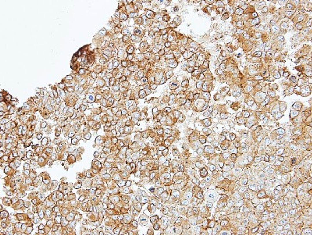 Immunohistochemistry-Paraffin: Junctional Adhesion Molecule 2 Antibody [NBP1-32655] - Paraffin-embedded TOV-112D xenograft, using antibody at 1:100 dilution.