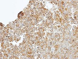 Immunohistochemistry-Paraffin: Junctional Adhesion Molecule 2 Antibody [NBP1-32655] - Paraffin-embedded TOV-112D xenograft, using antibody at 1:100 dilution.