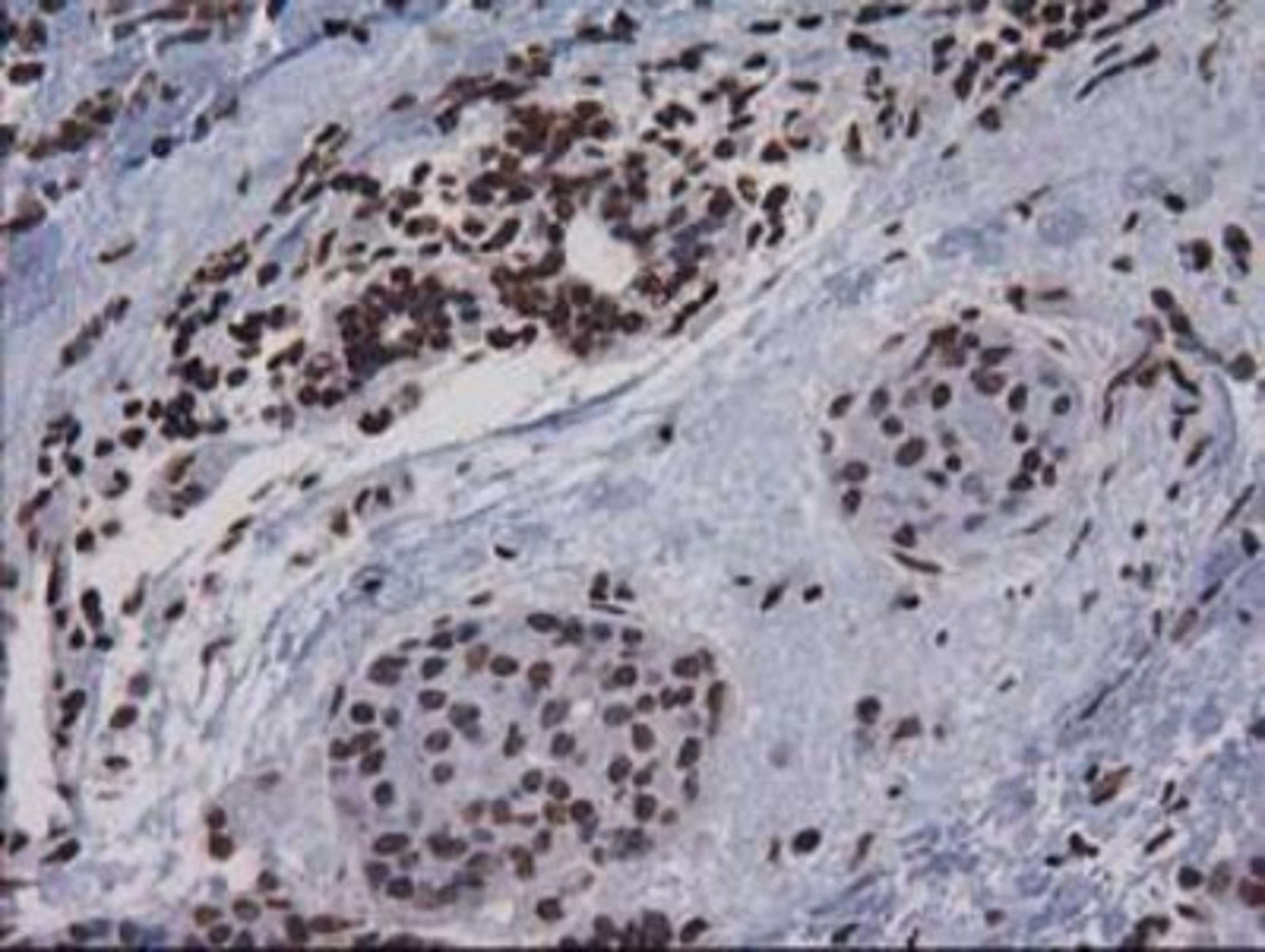 Immunohistochemistry-Paraffin: CTDSP1 Antibody (1B6) [NBP2-03456] - Staining of paraffin-embedded Adenocarcinoma of Human breast tissue using anti-CTDSP1 mouse monoclonal antibody.