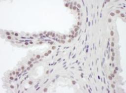 Immunohistochemistry-Paraffin: BAF180/PB1 Antibody [NB100-79833] - Section of human prostate carcinoma.