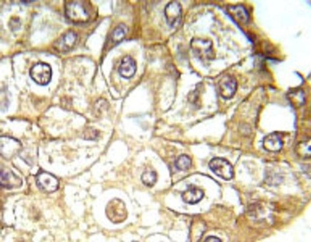 Immunohistochemistry-Paraffin: ERK1 [p Thr202, p Tyr204] Antibody [NBP1-19924] - Paraffin-embedded human breast carcinoma tissue.