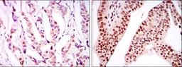 Immunohistochemistry: LEDGF Antibody (6E4) [NBP2-37646] - Immunohistochemical analysis of paraffin-embedded breast cancer tissues (left) and ovarian cancer tissues (right) using PSIP1 mouse mAb with DAB staining.