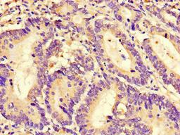 Immunohistochemistry of paraffin-embedded human colon cancer using CSB-PA019656LA01HU at dilution of 1:100