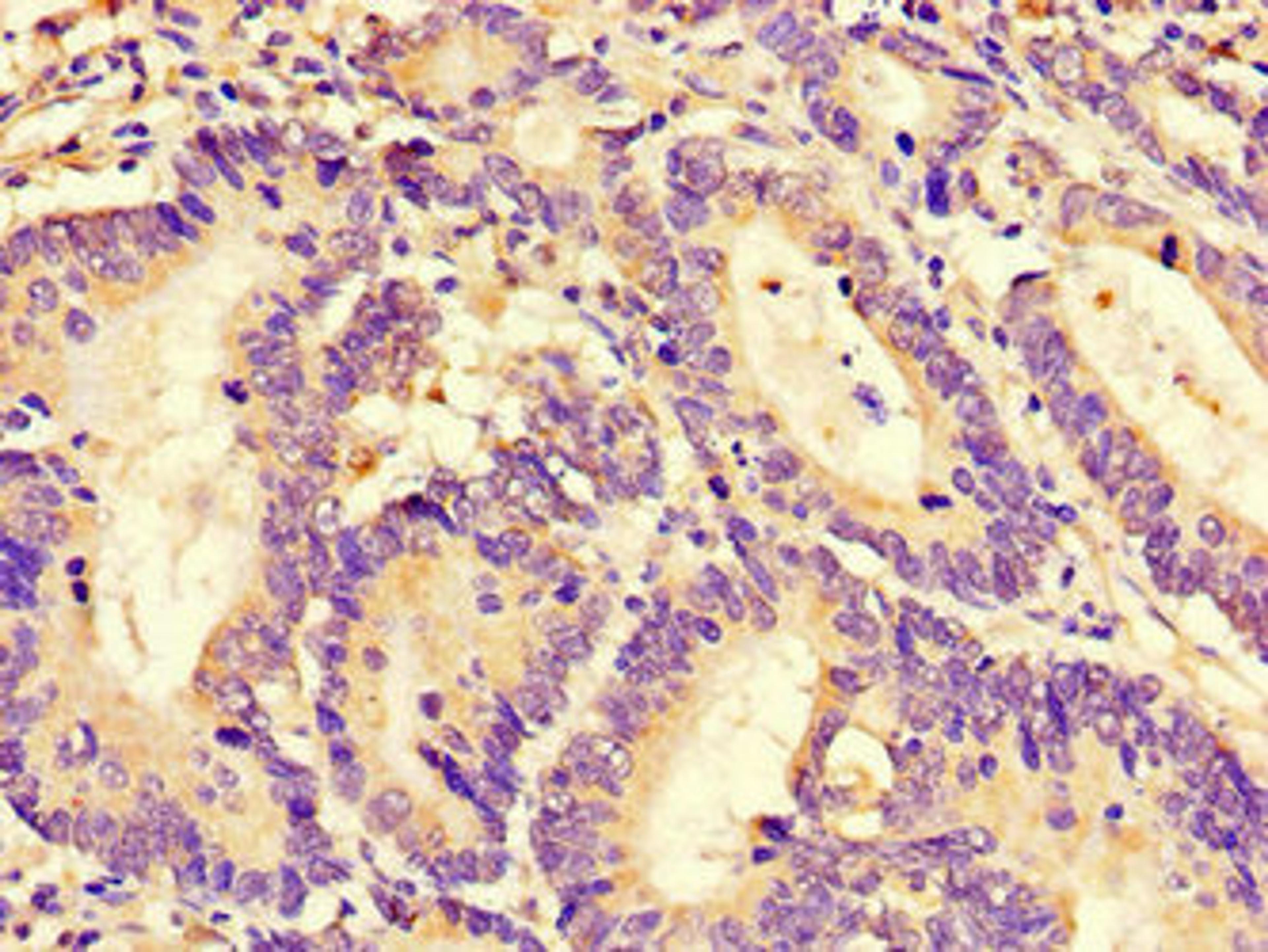 Immunohistochemistry of paraffin-embedded human colon cancer using CSB-PA019656LA01HU at dilution of 1:100