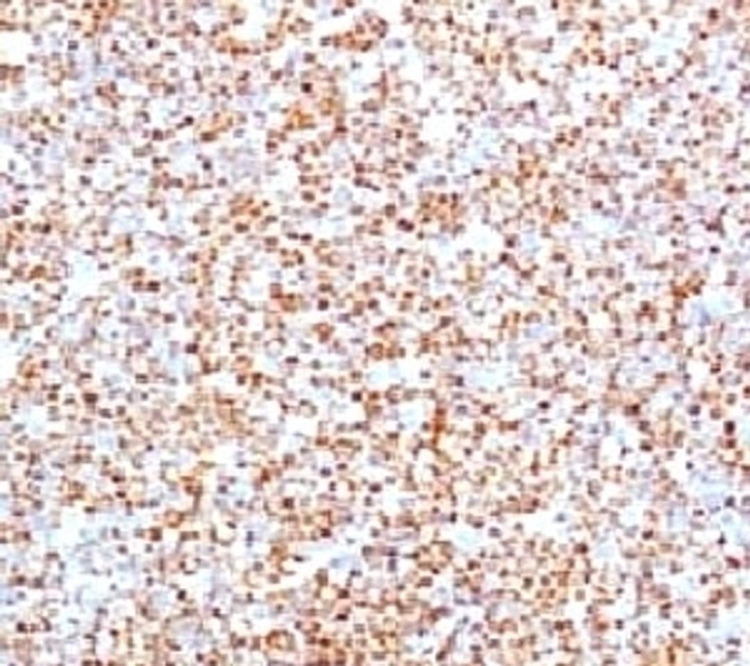 IHC testing of human mantle cell lymphoma and Cyclin D1 antibody (BCLD1-1).