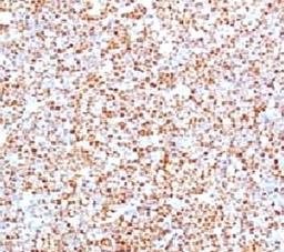 IHC testing of human mantle cell lymphoma and Cyclin D1 antibody (BCLD1-1).