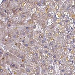 Immunohistochemistry: WBSCR16 Antibody [NBP2-31833] - liver cancer