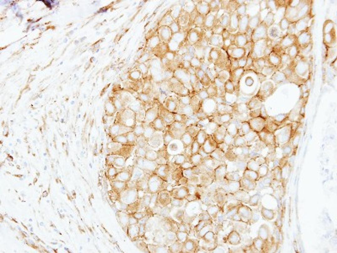 Immunohistochemistry-Paraffin: Cortactin Antibody [NBP2-15971] - Immunohistochemical analysis of paraffin-embedded Breast ca, using antibody at 1:250 dilution.