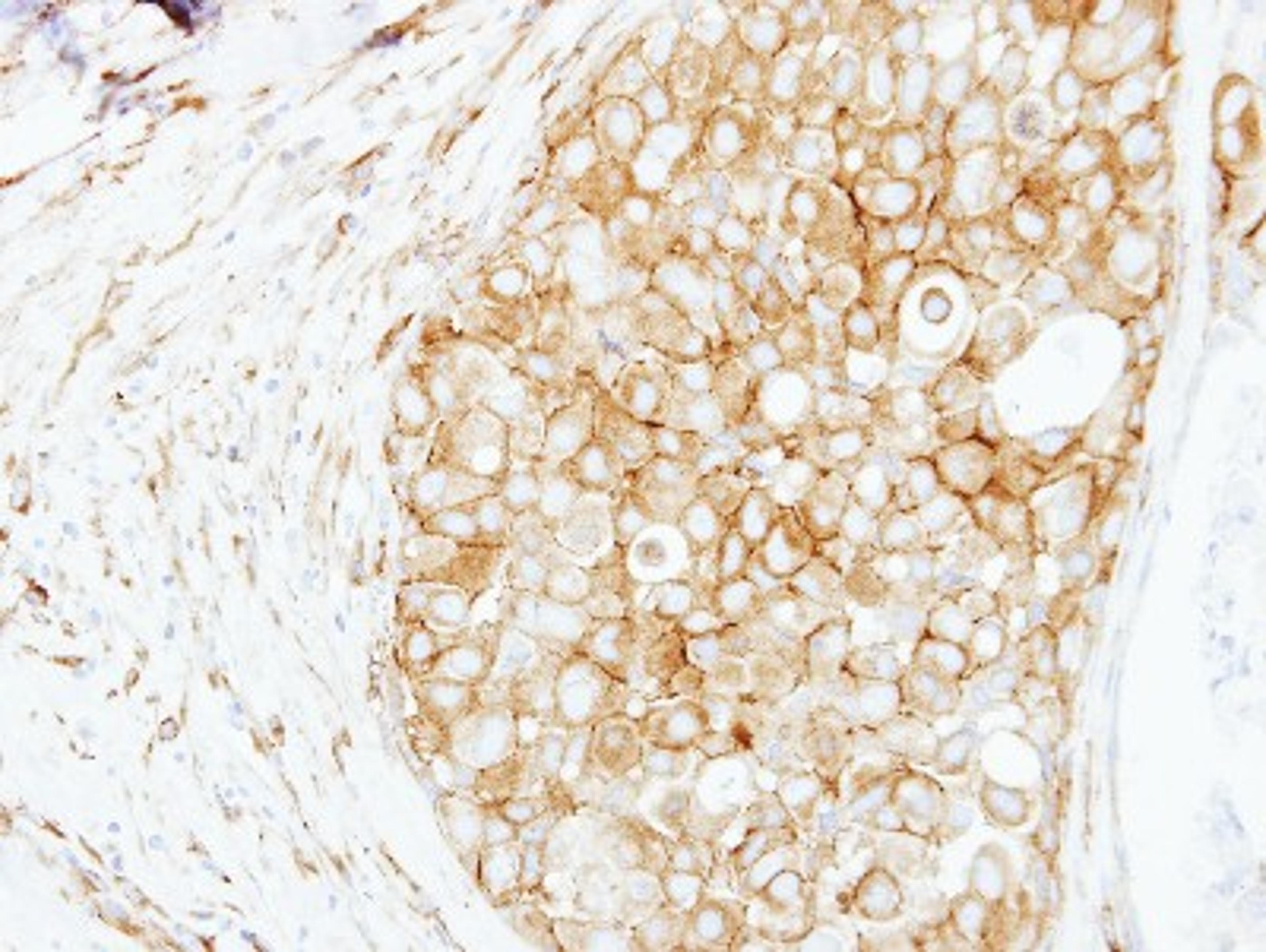 Immunohistochemistry-Paraffin: Cortactin Antibody [NBP2-15971] - Immunohistochemical analysis of paraffin-embedded Breast ca, using antibody at 1:250 dilution.