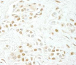 Immunohistochemistry-Paraffin: Cyclin C Antibody [NBP1-18878] - FFPE of human skin squamous cell carcinoma. Affinity purified rabbit anti-Cyclin C dilution of 1:100.