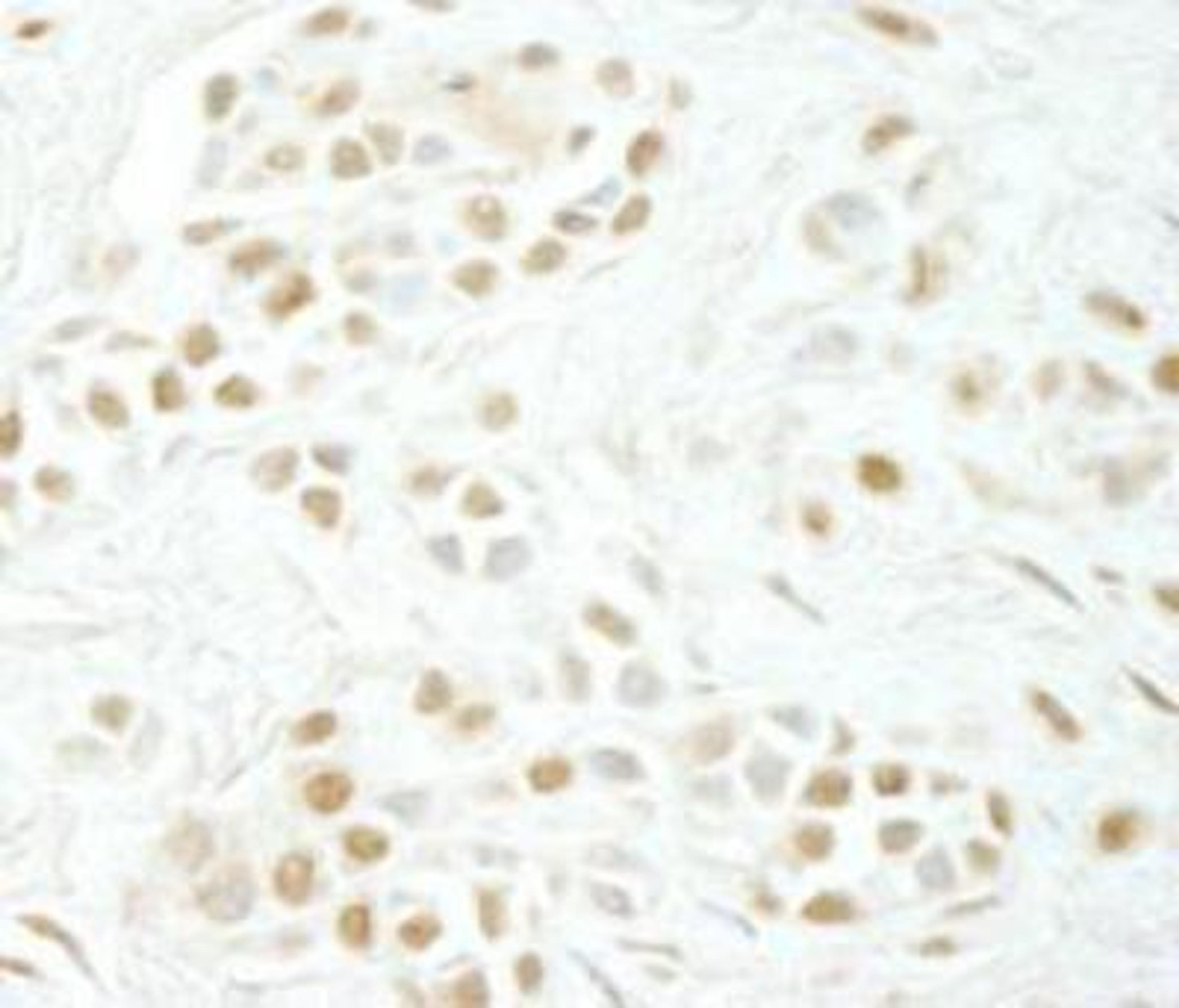 Immunohistochemistry-Paraffin: Cyclin C Antibody [NBP1-18878] - FFPE of human skin squamous cell carcinoma. Affinity purified rabbit anti-Cyclin C dilution of 1:100.