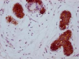 IHC image of CSB-MA785224 diluted at 1:100 and staining in paraffin-embedded human breast cancer performed on a Leica BondTM system. After dewaxing and hydration, antigen retrieval was mediated by high pressure in a citrate buffer (pH 6.0). Section was blocked with 10% normal goat serum 30min at RT. Then primary antibody (1% BSA) was incubated at 4°C overnight. The primary is detected by a Goat anti-mouse IgG polymer labeled by HRP and visualized using 0.05% DAB.