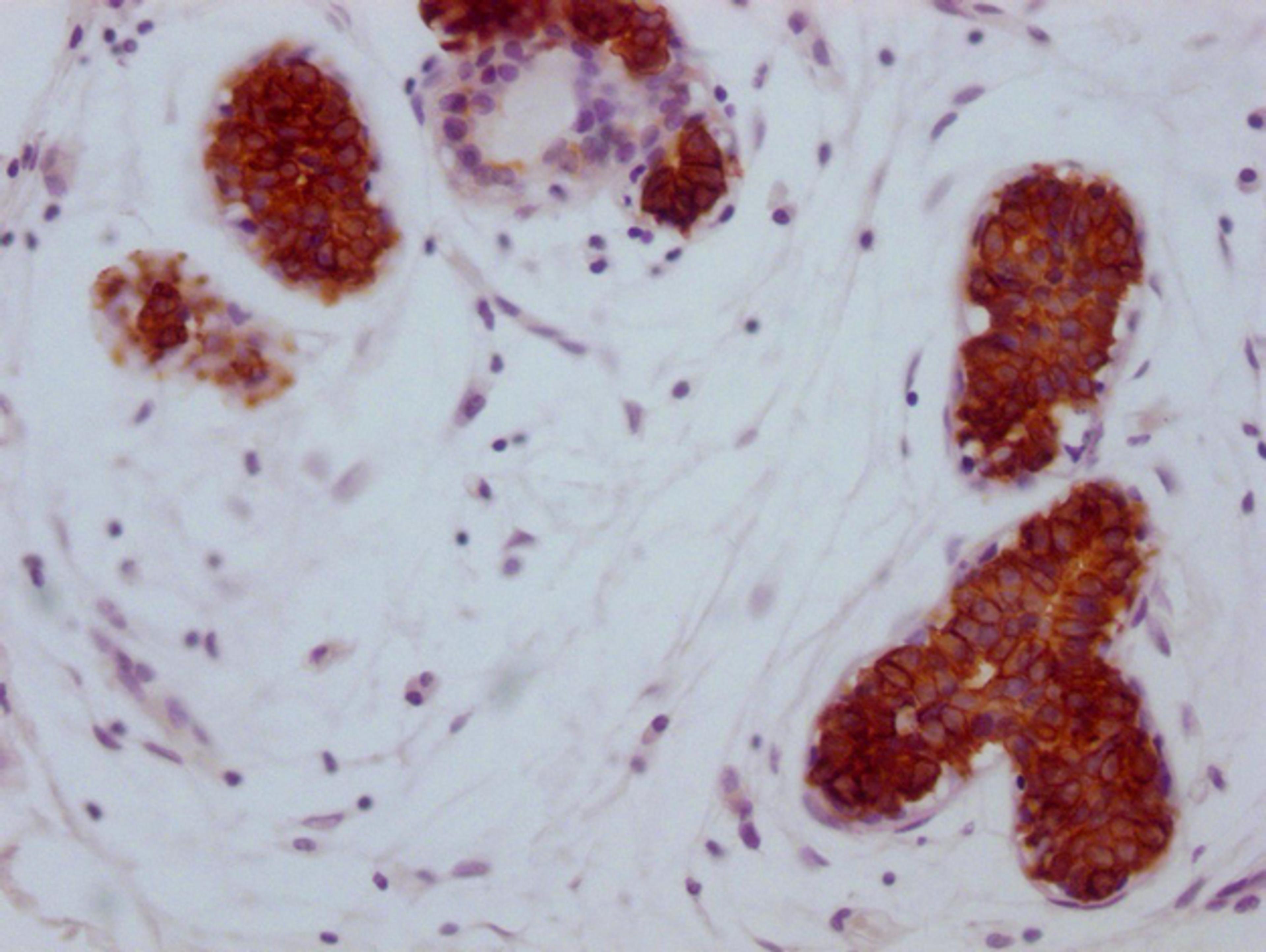 IHC image of CSB-MA785224 diluted at 1:100 and staining in paraffin-embedded human breast cancer performed on a Leica BondTM system. After dewaxing and hydration, antigen retrieval was mediated by high pressure in a citrate buffer (pH 6.0). Section was blocked with 10% normal goat serum 30min at RT. Then primary antibody (1% BSA) was incubated at 4°C overnight. The primary is detected by a Goat anti-mouse IgG polymer labeled by HRP and visualized using 0.05% DAB.