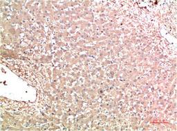 Immunohistochemical analysis of paraffin-embedded Human Liver Carcinoma Tissue using TTR Mouse mAb diluted at 1:200.