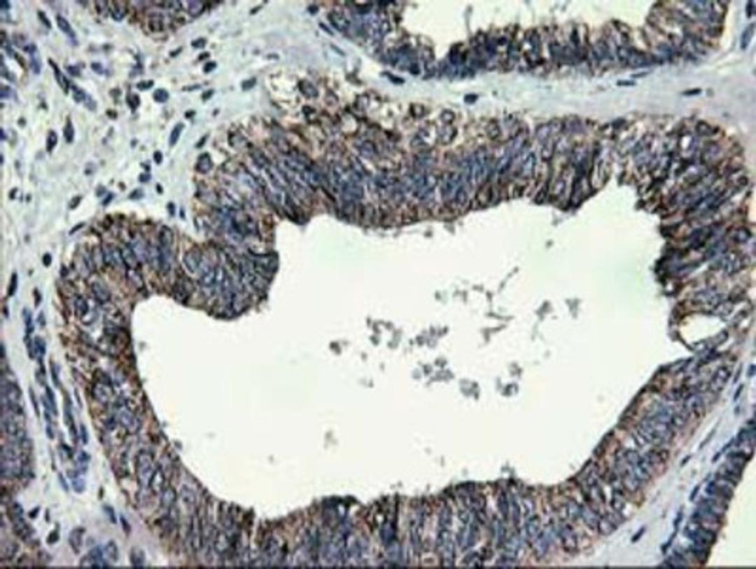 Immunohistochemistry-Paraffin: CCM2 Antibody (1E9) [NBP2-01134] - Staining of paraffin-embedded Adenocarcinoma of Human endometrium tissue using anti-CCM2 mouse monoclonal antibody.