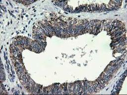 Immunohistochemistry-Paraffin: CCM2 Antibody (1E9) [NBP2-01134] - Staining of paraffin-embedded Adenocarcinoma of Human endometrium tissue using anti-CCM2 mouse monoclonal antibody.