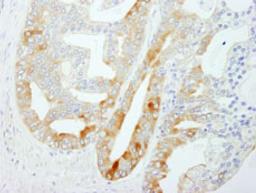 Detection of human FASN by immunohistochemistry.