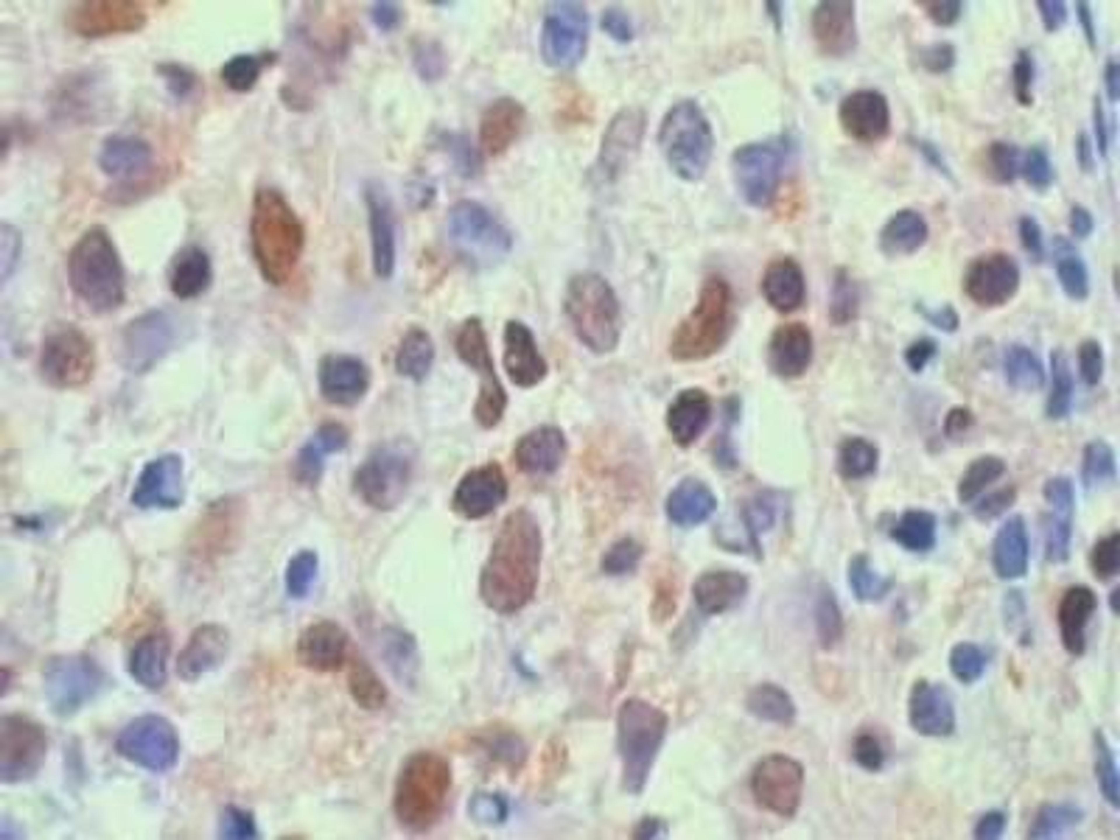 Immunohistochemistry-Paraffin: RelA/NFkB p65 Antibody [NB100-2176] - Staining of formalin-fixed, paraffin-embedded human DLBCL showing nuclear expression of NFkB p65 in the tumor cells.