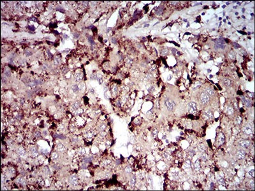 Immunohistochemistry: Phospholipase A2 XII Antibody (3H2C11) [NBP2-37255] - Immunohistochemical analysis of paraffin-embedded liver cancer tissues using PLA2G12A mouse mAb with DAB staining.