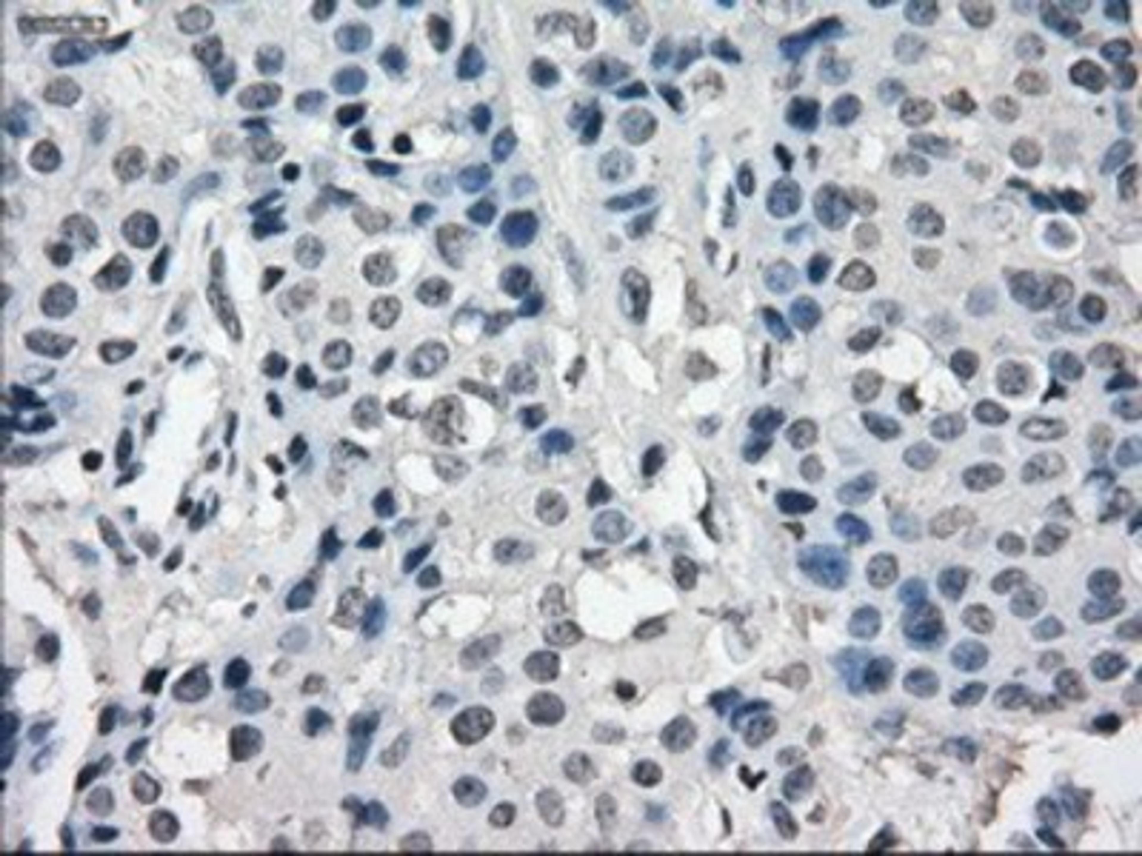 Immunohistochemistry-Paraffin: SLC7A8 Antibody (7D6) [NBP1-47989] - Staining of paraffin-embedded Adenocarcinoma of breast tissue using anti-SLC7A8 mouse monoclonal antibody.