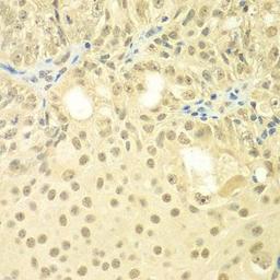 Immunohistochemical staining of human oophoroma tissue using TBL1XR1 antibody (dilution of 1:100)