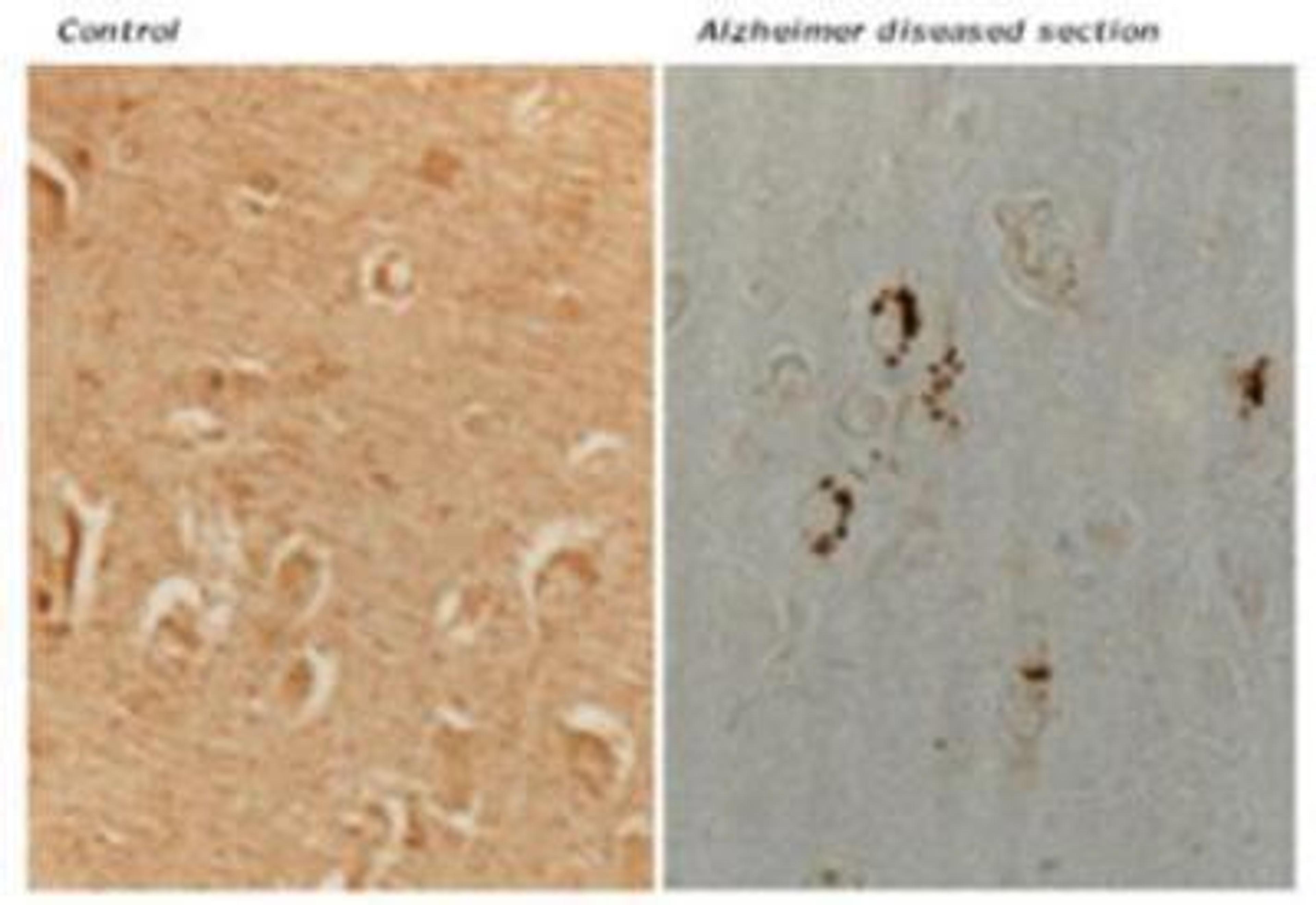 Immunohistochemistry: MKK6/MEK6 Antibody [NBP1-19267] - Analysis of MKK6. There is prominent MKK6 in association with neurons containing neurofibrillary pathology in hippocampal sections (CA1 area) from an AD patient with granular structure heavily stained (right). MKK6 is barely detected in control brain (left).