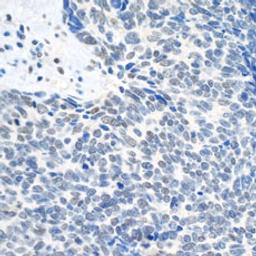 Detection of human Topo II Beta by immunohistochemistry.