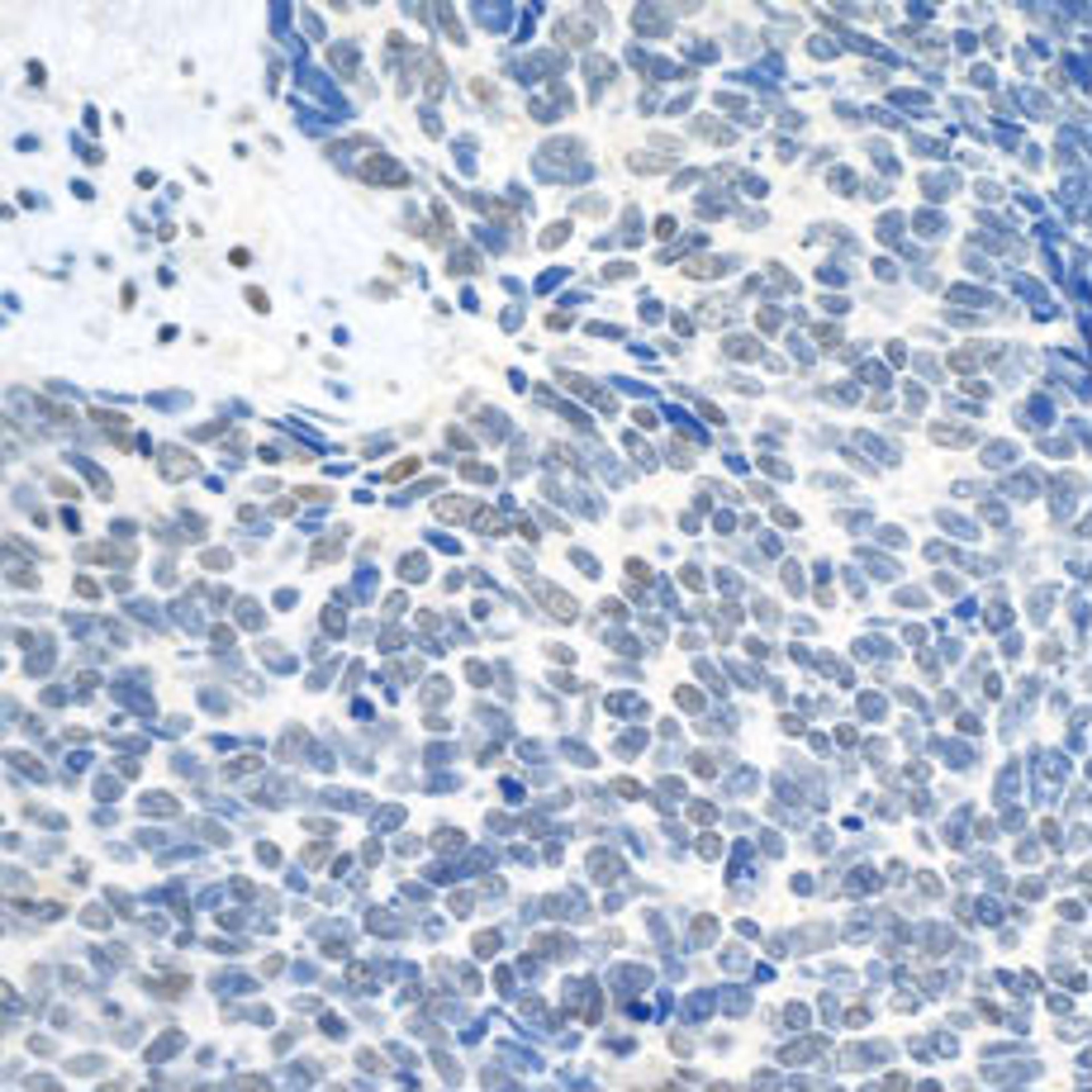 Detection of human Topo II Beta by immunohistochemistry.