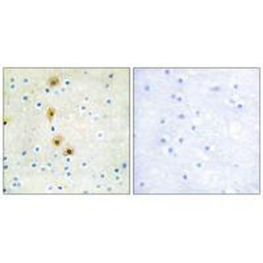 Immunohistochemistry analysis of paraffin-embedded human breast carcinoma tissue using Akt (Ab-326) antibody.