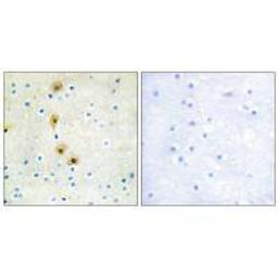 Immunohistochemistry analysis of paraffin-embedded human breast carcinoma tissue using Akt (Ab-326) antibody.