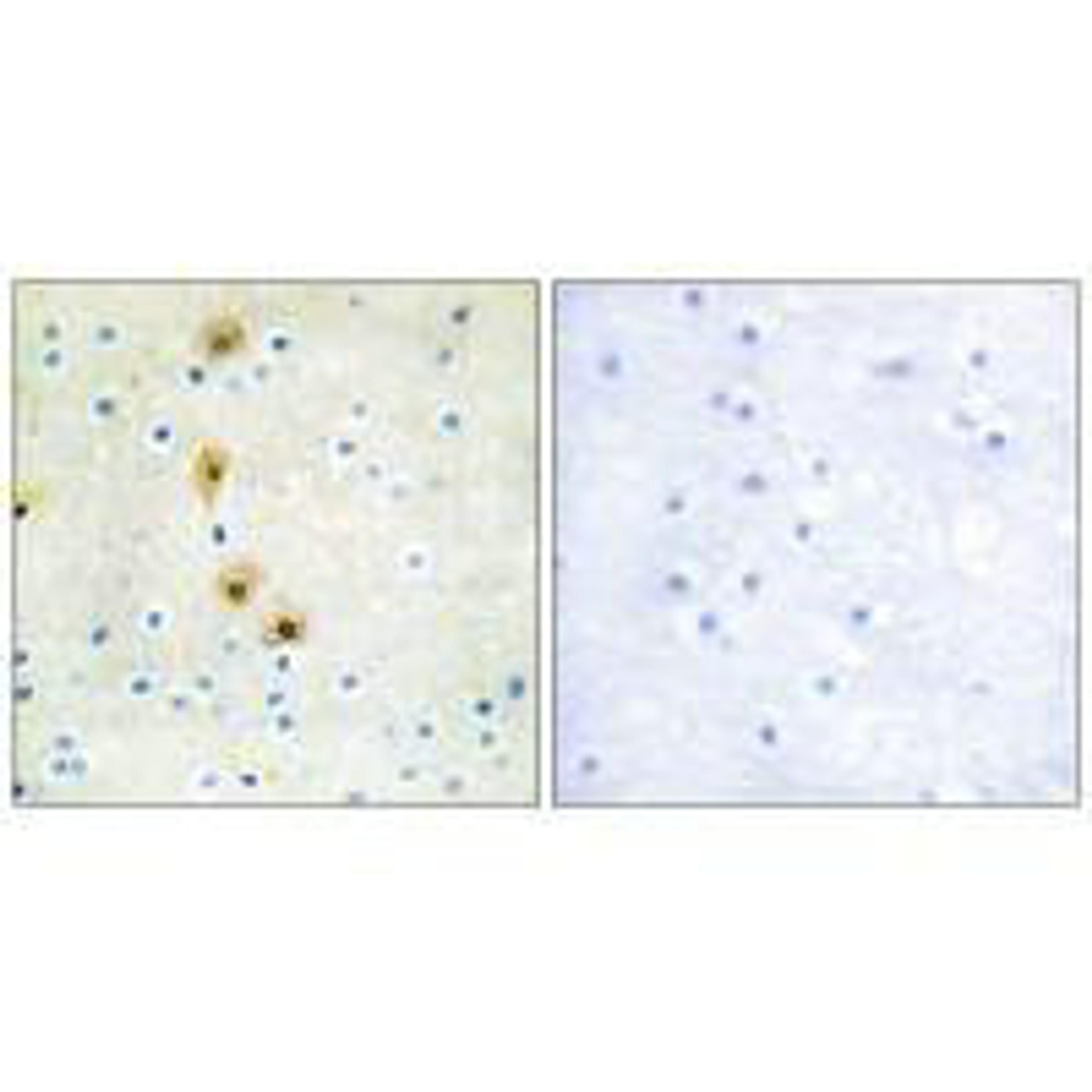 Immunohistochemistry analysis of paraffin-embedded human breast carcinoma tissue using Akt (Ab-326) antibody.
