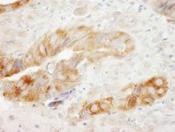 Immunohistochemistry-Paraffin: EEF1G Antibody [NB100-2262] - Human colon carcinoma.  Antibody used at a dilution of 1:200.