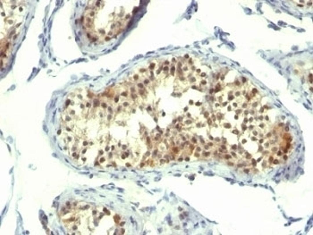 Formalin-fixed, paraffin-embedded human testicular carcinoma stained with Thymidylate Synthase antibody (TMS715).