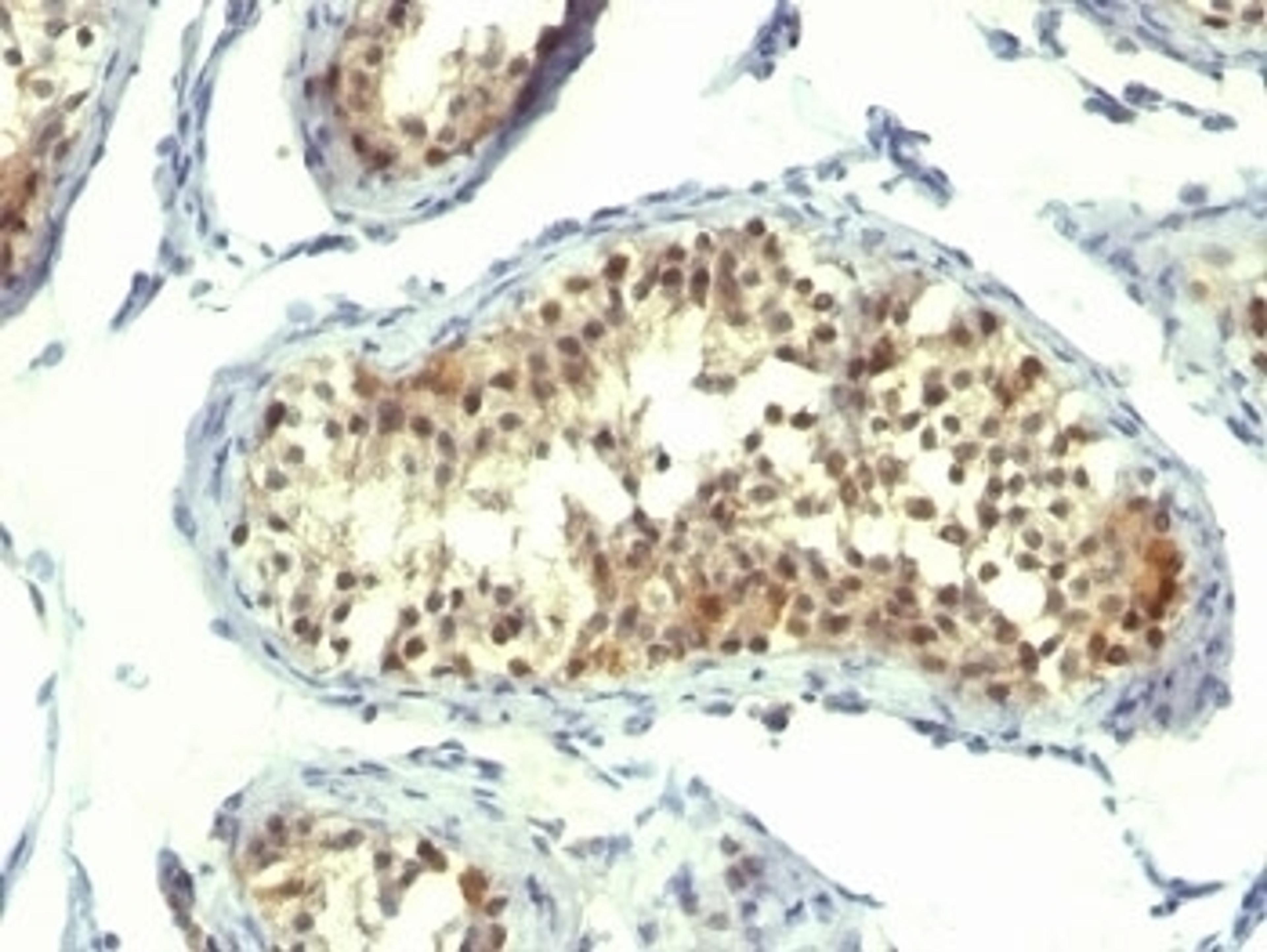 Formalin-fixed, paraffin-embedded human testicular carcinoma stained with Thymidylate Synthase antibody (TMS715).