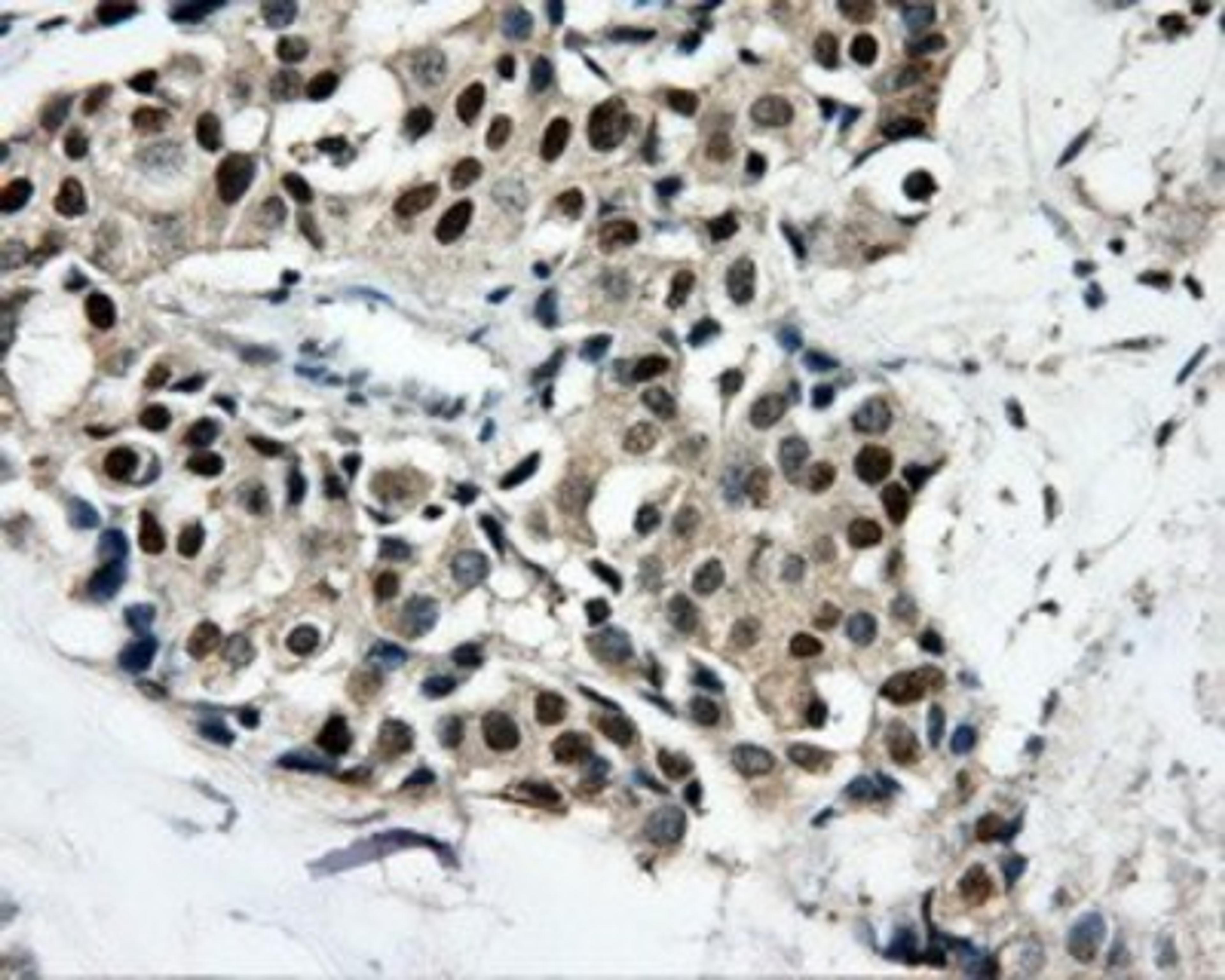 Immunohistochemistry-Paraffin: CAMKID Antibody (2C6) [NBP2-02314] - Staining of paraffin-embedded Adenocarcinoma of breast tissue using anti-CAMKID mouse monoclonal antibody.