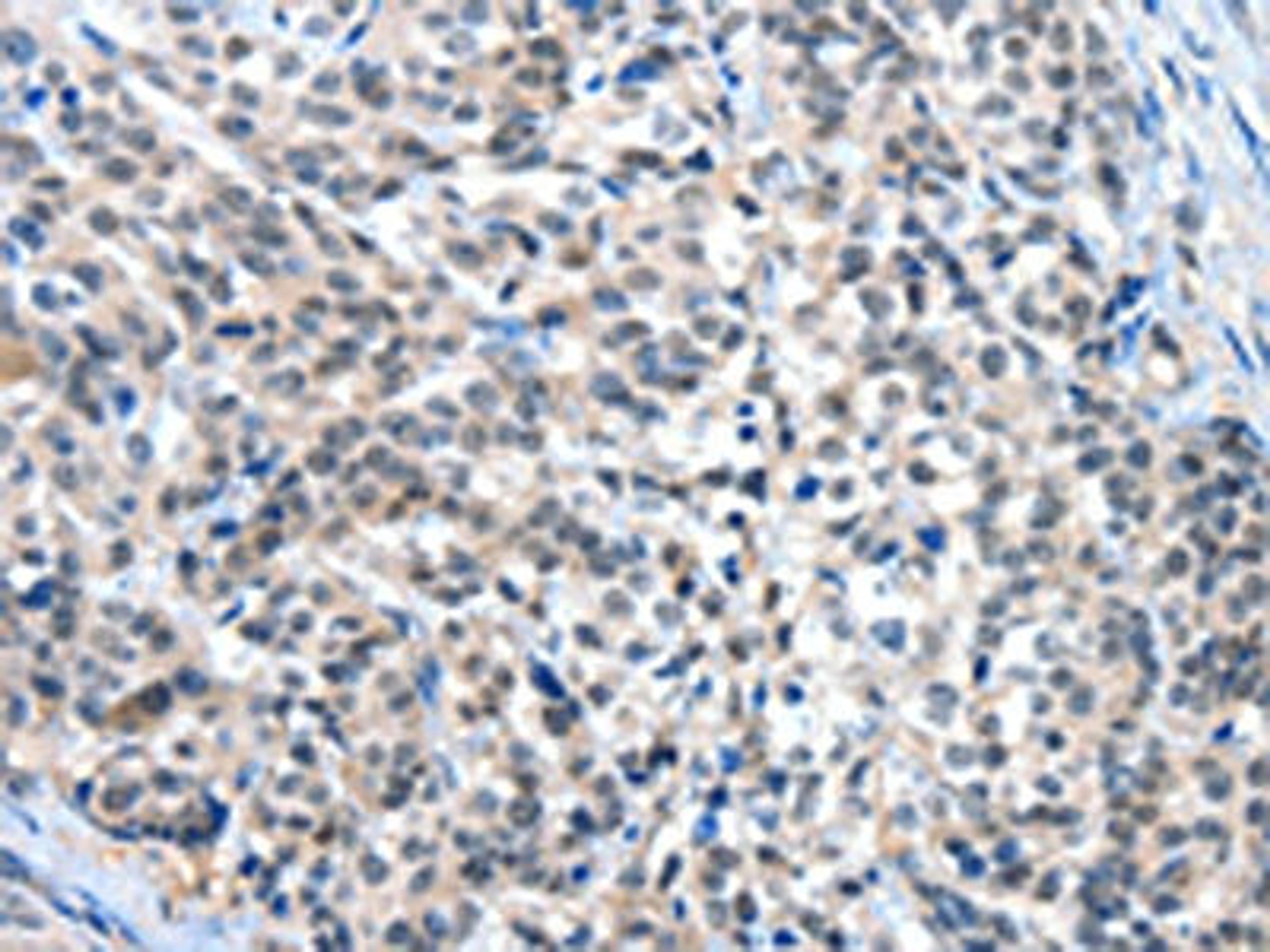 The image on the left is immunohistochemistry of paraffin-embedded Human esophagus cancer tissue using CSB-PA588410(EIF4EBP1 Antibody) at dilution 1/30, on the right is treated with fusion protein. (Original magnification: ×200)