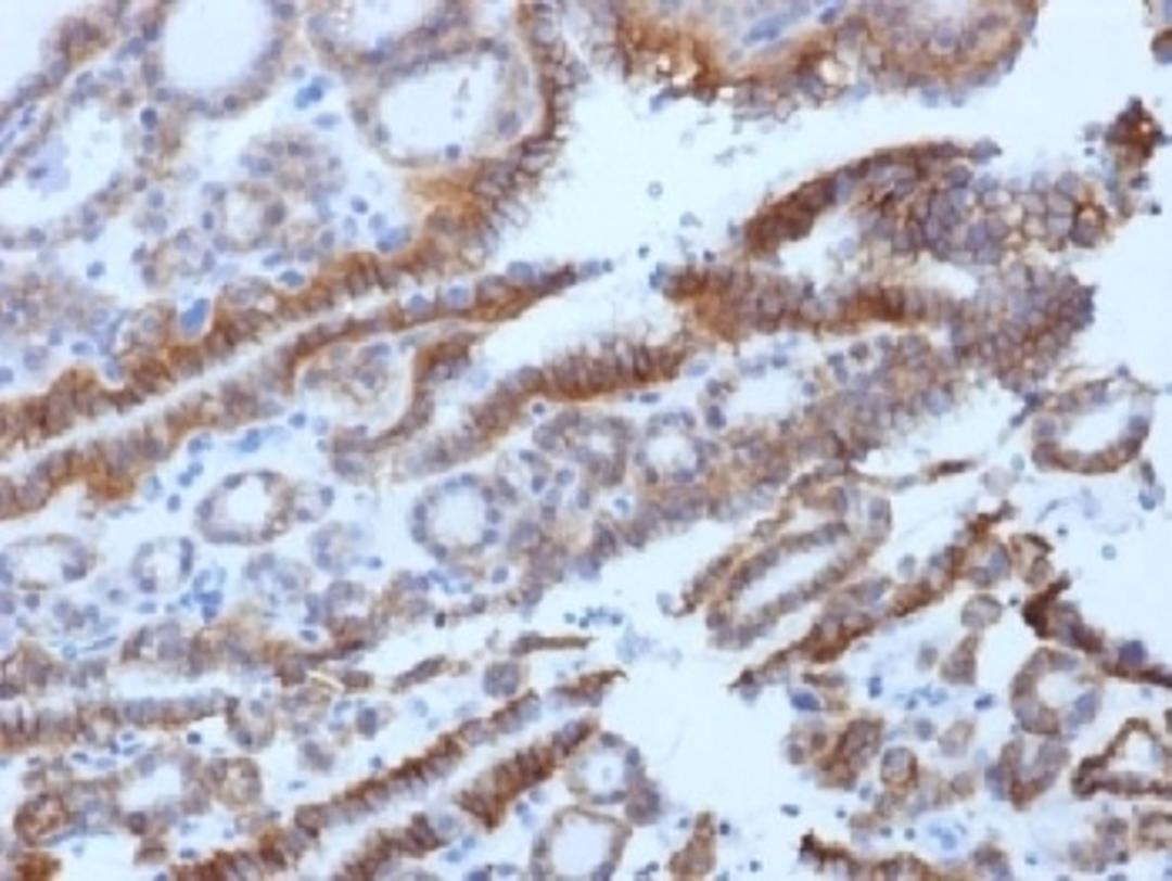 IHC testing of FFPE human thyroid carcinoma with TSH Receptor antibody (clone SPM222). Required HIER: boil tissue sections in 10mM Tris buffer with 1mM EDTA, pH 8, for 10-20 min followed by cooling at RT for 20 min.