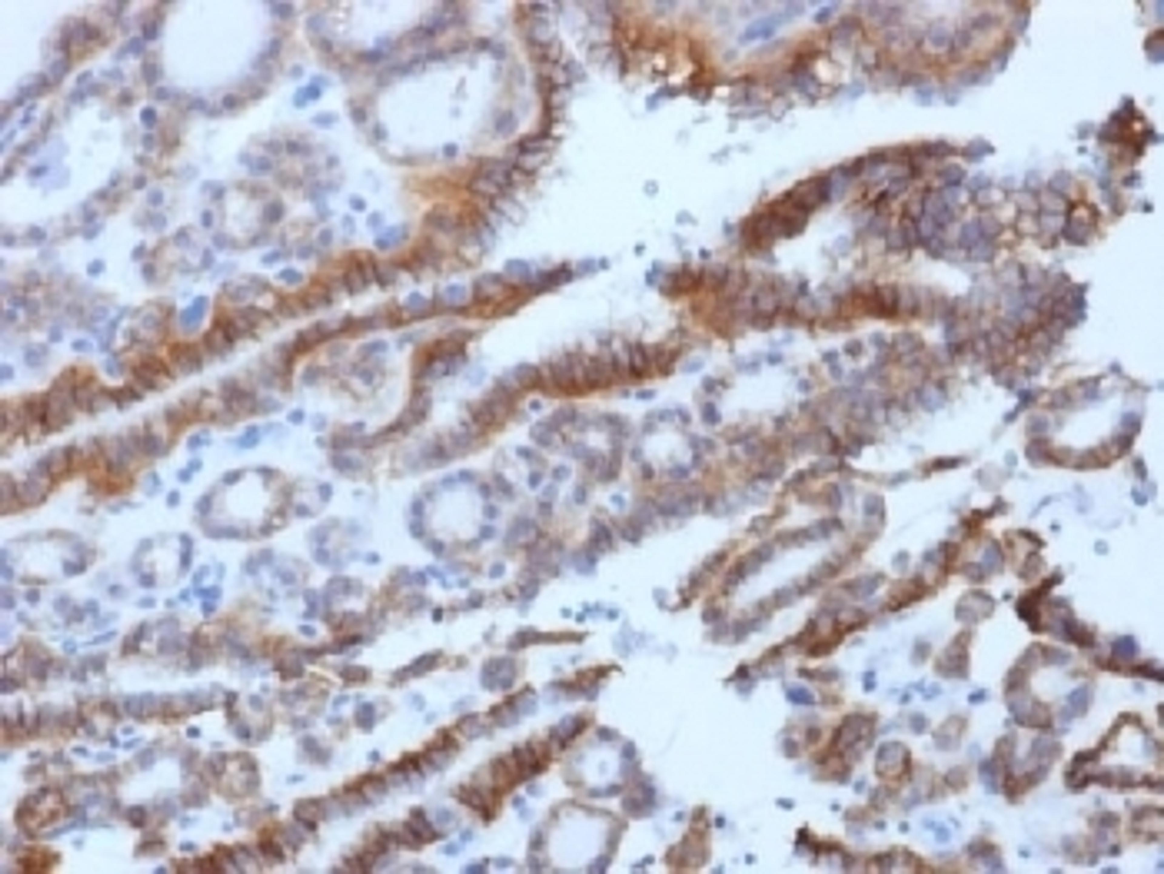 IHC testing of FFPE human thyroid carcinoma with TSH Receptor antibody (clone SPM222). Required HIER: boil tissue sections in 10mM Tris buffer with 1mM EDTA, pH 8, for 10-20 min followed by cooling at RT for 20 min.